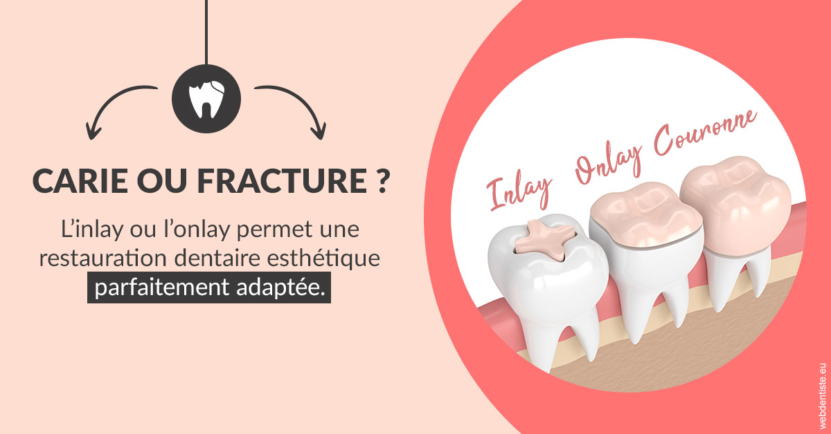 https://www.centredentaireleluc.fr/T2 2023 - Carie ou fracture 2