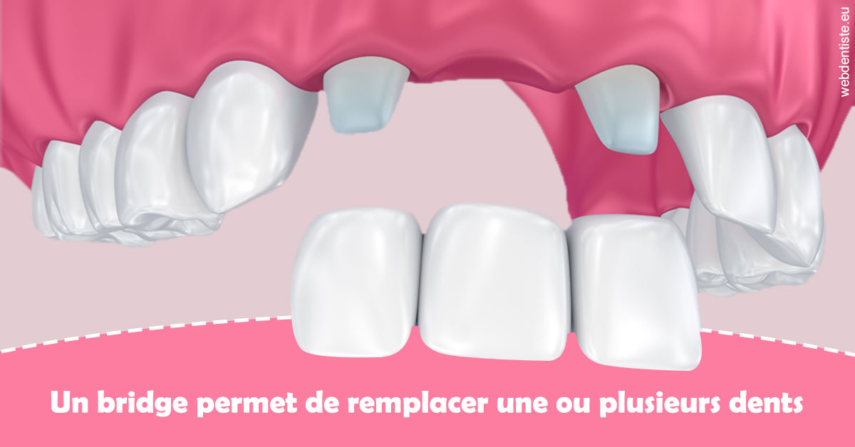 https://www.centredentaireleluc.fr/Bridge remplacer dents 2