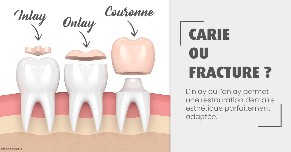 https://www.centredentaireleluc.fr/T2 2023 - Carie ou fracture 1