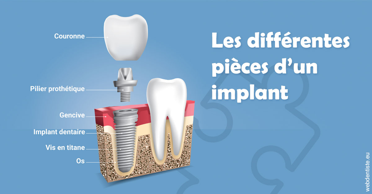 https://www.centredentaireleluc.fr/Les différentes pièces d’un implant 1
